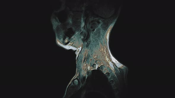 Bulk Multicolored MRI of the Cervical Spine, Detection of Protrusions and Hernias