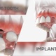 Canine tooth Implant - VideoHive Item for Sale