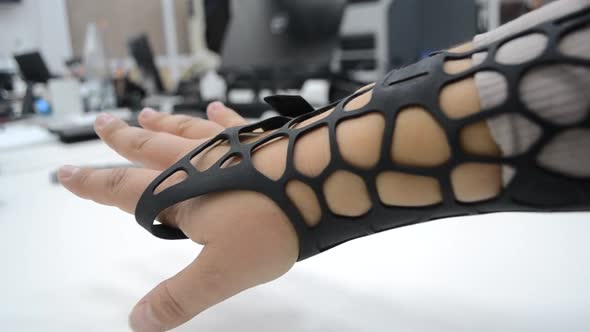 Black Orthopedic Plastic Prosthesis Printed on Powder 3D Printer on Hand