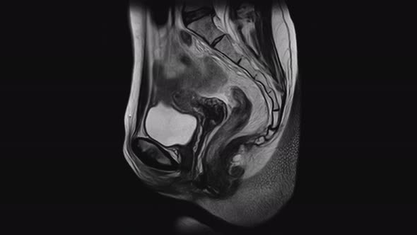 MRI of the Female Pelvic Organs, Abdominal Cavity, Gastrointestinal Tract and Bladder