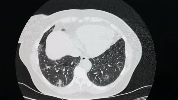 CT of Lungs with Confirmed Case of Coronavirus Covid19 Respiratory Disease