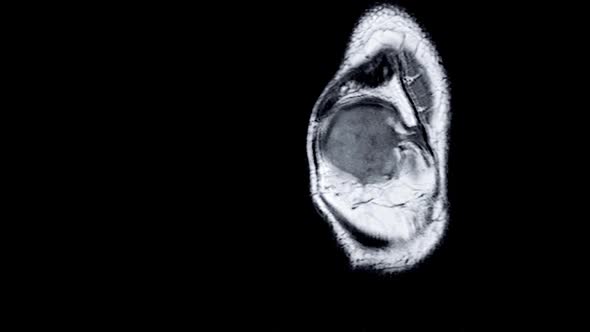 Magnetic Resonance Imaging (MRI) of Right Knee