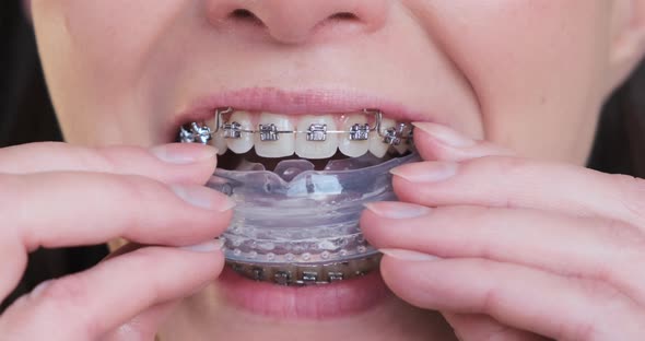 Woman Puts on Training Mouth Guard for Jaw Closeup