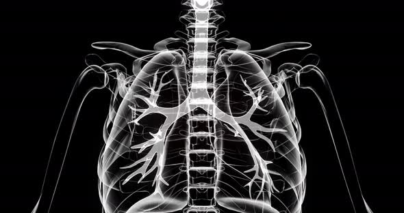 Lung disease. Inflammation of the lungs in humans. X-ray of a person on a black background