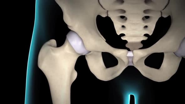 3D animation of Rheumatoid arthritis of hip joint