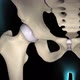 3D animation of Rheumatoid arthritis of hip joint - VideoHive Item for Sale