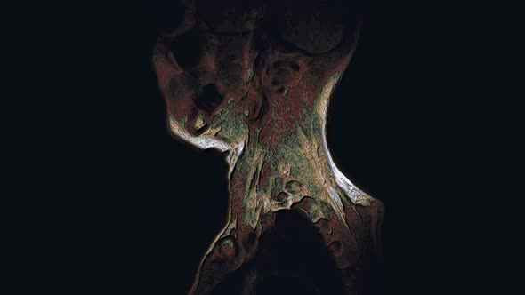 Bulk Multicolored MRI of the Cervical Spine, Detection of Protrusions and Hernias
