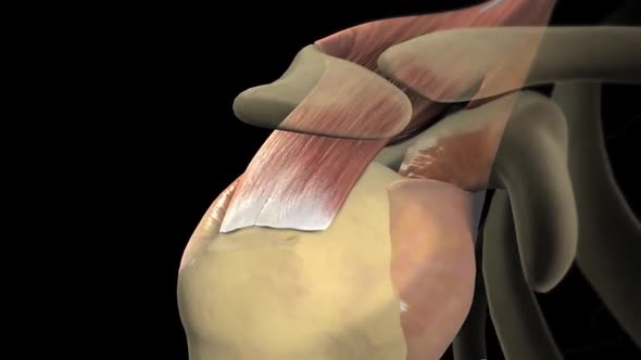 This video shows the rotator cuff surgery