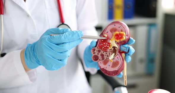 Doctor Nephrologist Showing Kidney Disease on Artificial Model Closeup  Movie Slow Motion