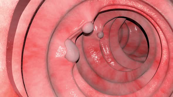 Overview Of The Intestinal Polyps