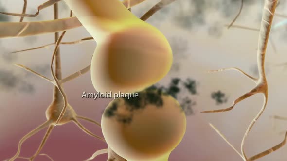 Amyloid Plaques. The beta-amyloid protein involved in Alzheimer's disease