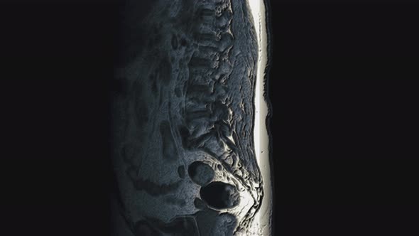 Postoperative Voluminous Color MRI of Female Organs for the Detection of Metastases