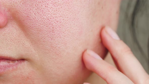 Macro Skin with Enlarged Pores. The Girl Touches the Irritated Red Skin with Her Fingers. Allergic