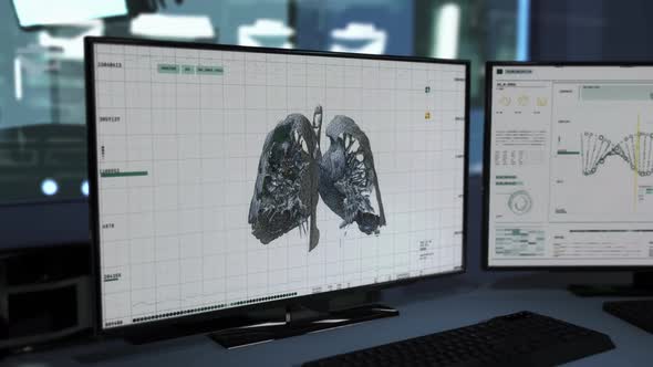 Major damage to the lungs of a Covid-19 patient shown on the CT scan images alt