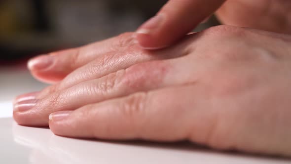 Girl or Woman Smears Eczema on Her Hands with Special Healing Ointment. Red Swollen Fingers Require