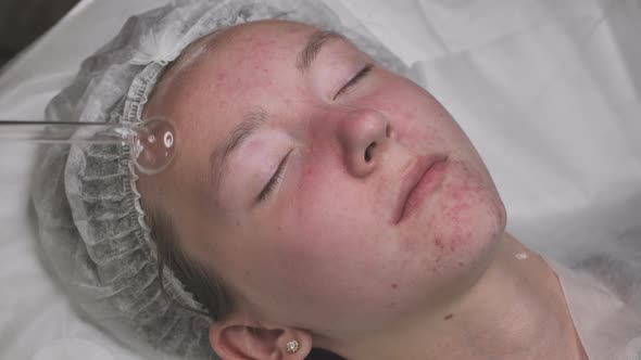 Darsonvalization of the Face in a Young Girl with Problem Skin