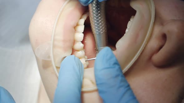 Closeup of a Dentist's Hand in Medical Gloves Works with a Patient in a Dental Office