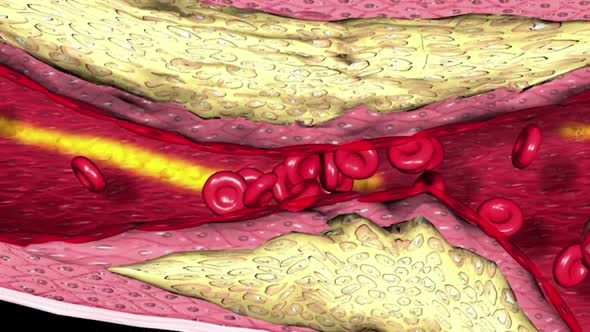 Blood clotting in the circulatory system