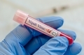 Nipah virus positive blood sample - PhotoDune Item for Sale