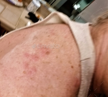 oomer with Shingles, Even After Having a Shingles Vaccination! Being treated by the dermatologist.
