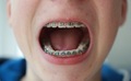 Mouth open with teeth and braces. Teenage skin, beauty and health.  - PhotoDune Item for Sale