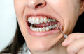 Woman with open mouth using dental buttons and elastic band for orthodontic treatment - PhotoDune Item for Sale