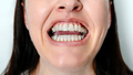 Woman with open mouth using orthodontic treatment with transparent removable aligners - PhotoDune Item for Sale