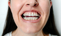 Woman with open mouth showing attachments and dental buttons for orthodontic treatment - PhotoDune Item for Sale
