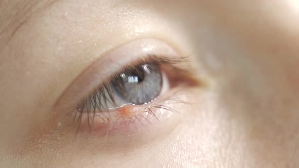 Young Woman with Hordeolum Disease in the Eye