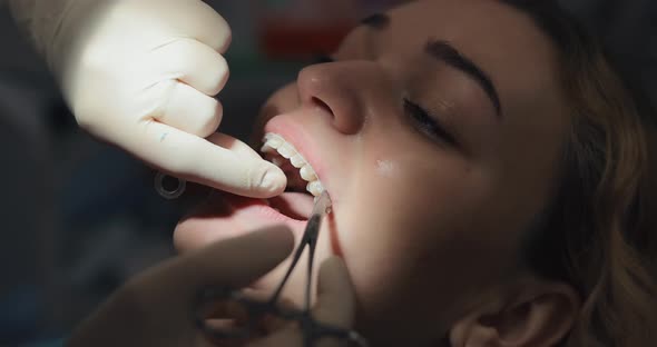 Orthodontist Attaches the Ligatures to the Patient's Braces