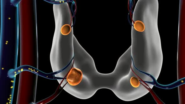 Overview of Parathyroid Disease- tumor growth