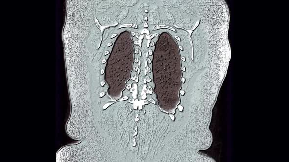 3D Monochrome MRI Scan of The Lungs and Bronchi