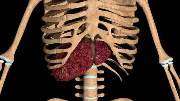 Human Skeleton With Liver Affected By Cirrhosis