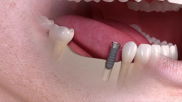 Implant And Crown Installation Process. 3D Medical Animated video