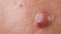 Big Acne Cyst Abscess or Ulcer Swollen area within face skin tissue. - PhotoDune Item for Sale