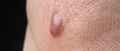 Big Acne Cyst Abscess or Ulcer Swollen area within face skin tissue. - PhotoDune Item for Sale
