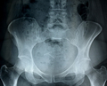 X ray of a female pelvis, hip bones and IUD - PhotoDune Item for Sale