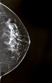 Mammogram image of a breast - PhotoDune Item for Sale