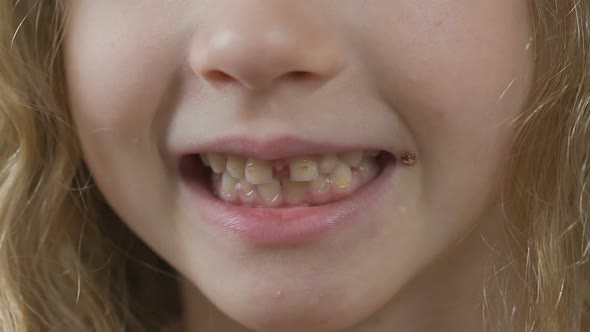 Small Kid Smiling and Showing Gums and Teeth With Dental Caries, Yellow Spots