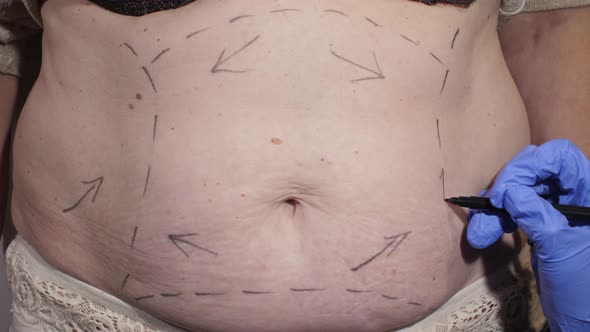 The Surgeon Marks the Abdomen for Liposuction