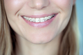Adult woman with a braces - PhotoDune Item for Sale