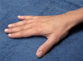 Hand with an acupuncture needle as a treatment - PhotoDune Item for Sale