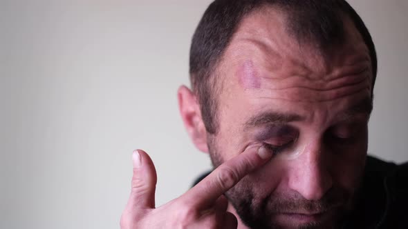 An Alcoholic Man Lubricates the Hematoma Cream Under the Eye