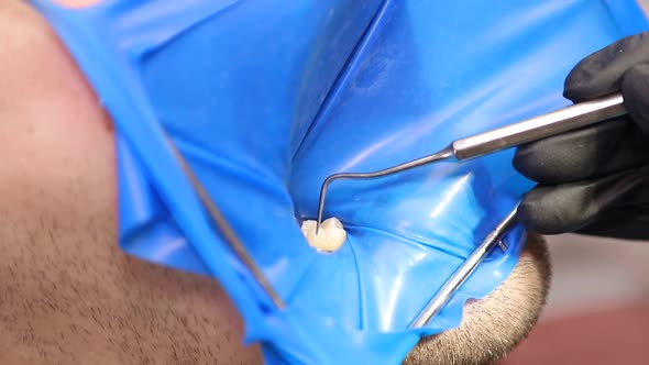 A man treats the teeth of a woman doctor, a dentist's job in the office, healthy teeth