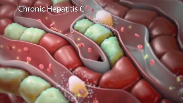 Chronic Hepatitis B with medical