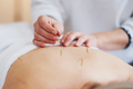A acupuncture needle therapy in the studio - PhotoDune Item for Sale