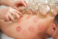 A picture of a man having cupping therapy - PhotoDune Item for Sale