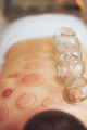 A picture of a man having cupping therapy - PhotoDune Item for Sale