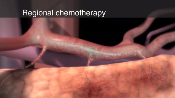 Brachytherapy is a type of radiotherapy,