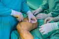 Surgical room procedures are commonly employed for the removal of varicose veins in patients. - PhotoDune Item for Sale